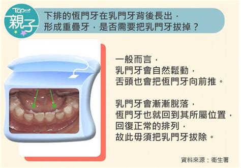 6歲出大牙|【兒童換牙】小朋友幾歲出牙換牙？ 一文看清兒童換。